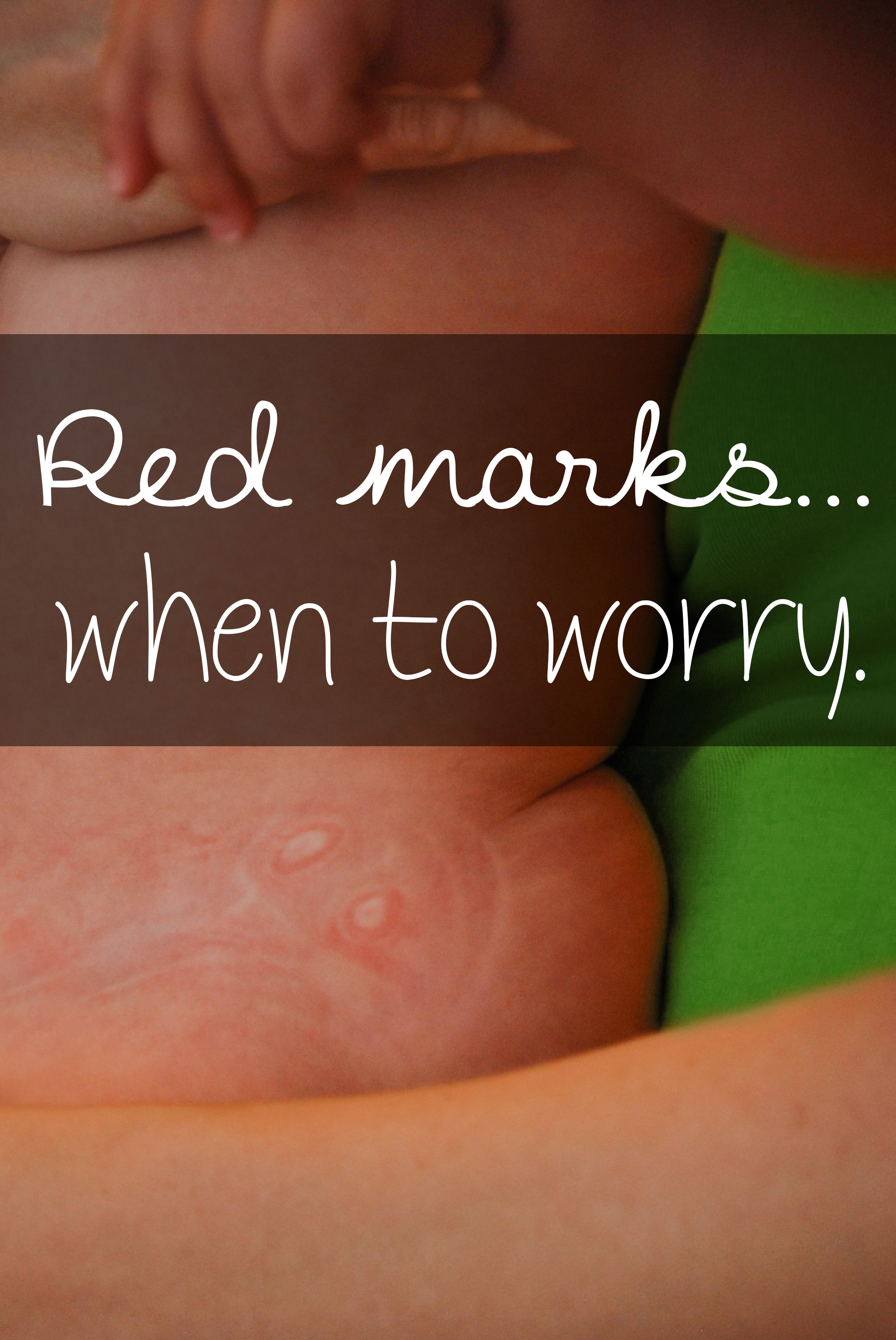 Red marks can be normal, but sometimes it’s part of a bigger problem. Click to find out how to determine the difference!